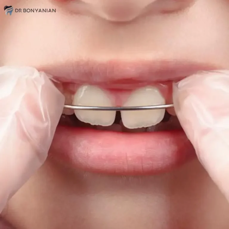 مال اکلوژن دندان چیست؛ عوامل ایجاد آن و درمان