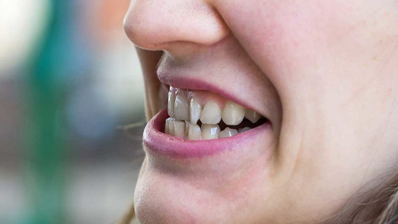 مال اکلوژن دندان چیست؟
