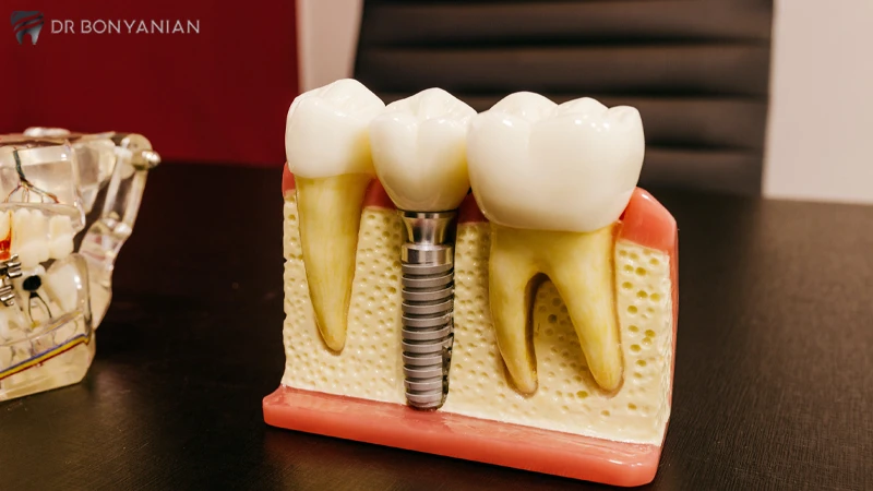 طول درمان ایمپلنت از نظر محل قرار گیری دندان و نوع روش جراحی