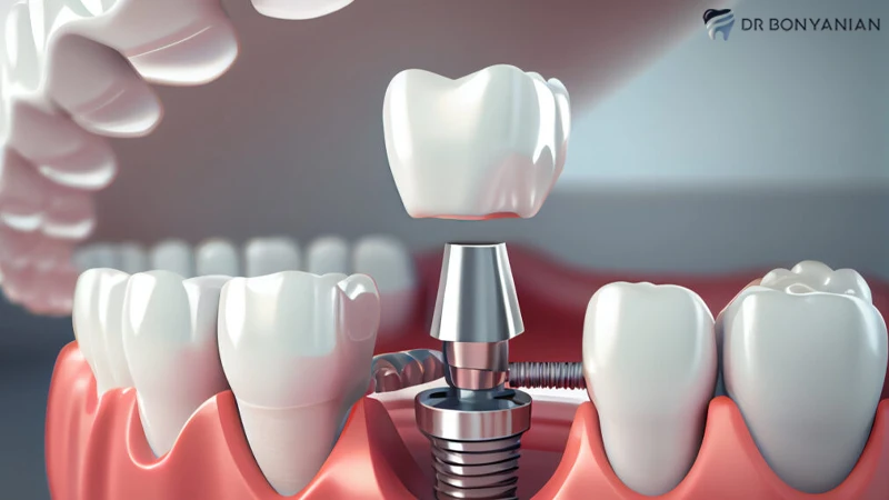 ایمپلنت دندان چقدر طول میکشد
