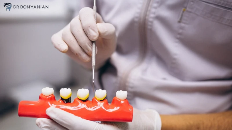 زمان بهبودی انواع ایمپلنت دندان