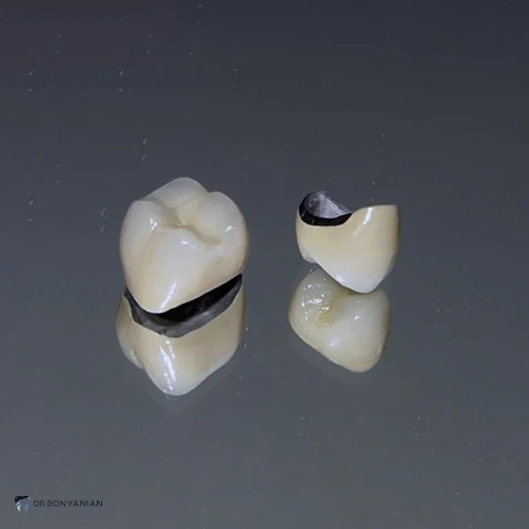 بازسازی تاج دندان