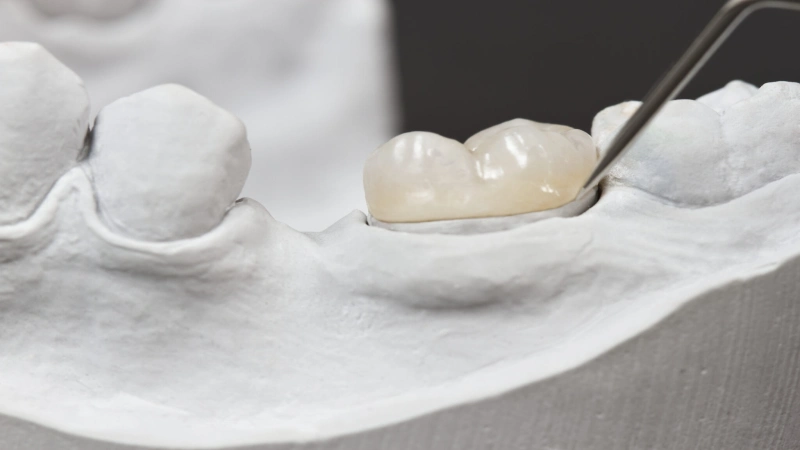 مواد مورد استفاده برای بازسازی تاج دندان