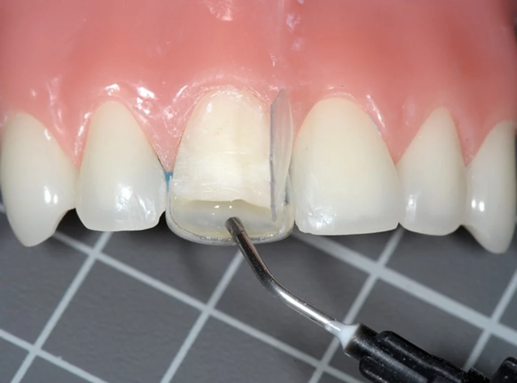 ترمیم کردن دندان با کامپوزیت یا روش باندینگ رزین
