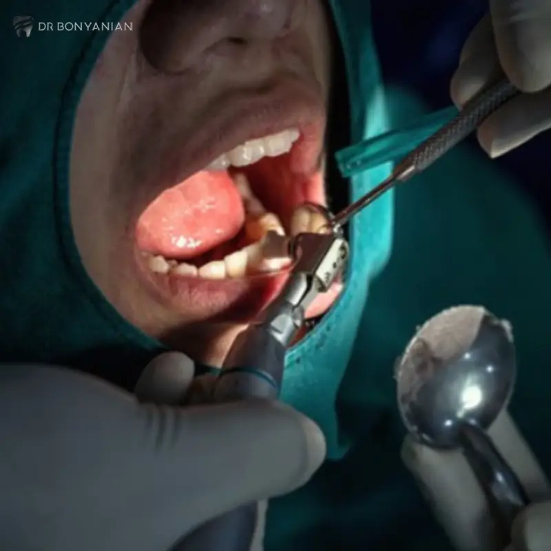 وستیبولوپلاستی چیست؛ مزیت‌های جراحی آن