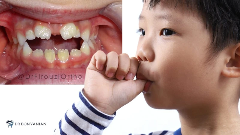 عوارض مکیدن انگشت شست یا دیگر انگشتان