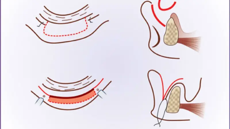 درمان وستیبولوپلاستی توسط دندانپزشکی دکتر بنیانیان