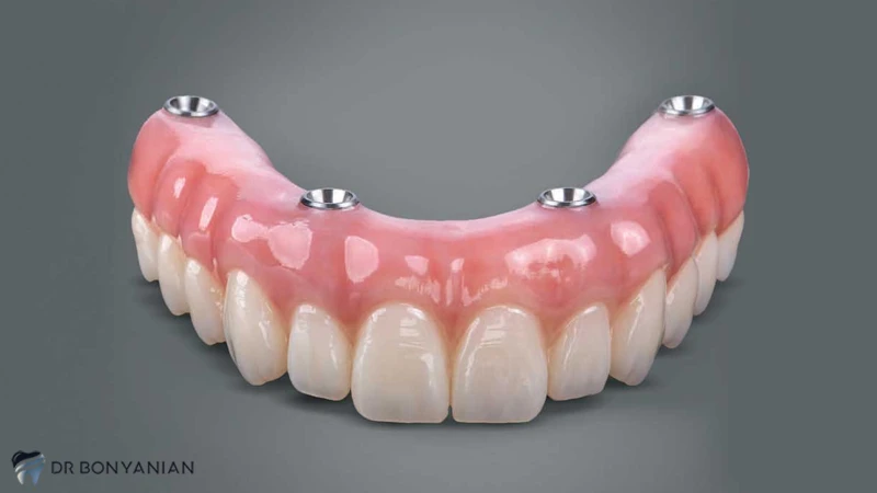 جایگزینی دندان از دست رفته با پروتز