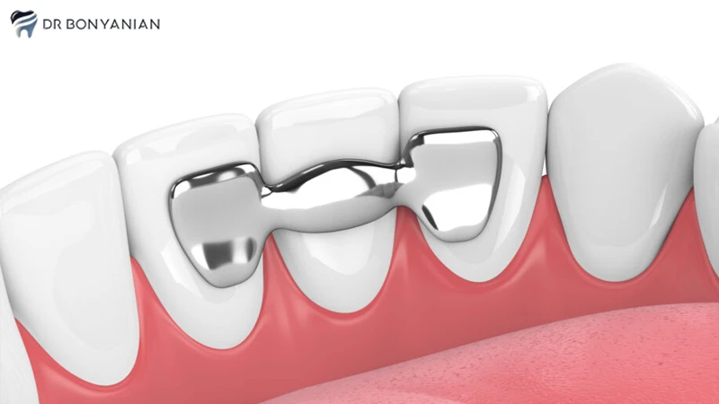 جایگزینی دندان با بریج