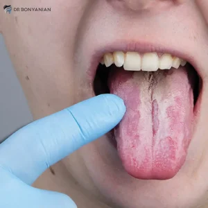 لوکوپلاکیا چیست؛ علل و درمان لکه های سفید روی لثه