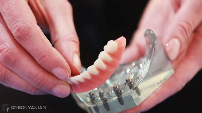 معایب اوردنچر دندان