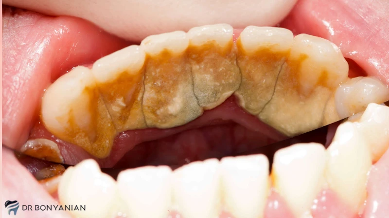 علل ایجاد جرم دندان