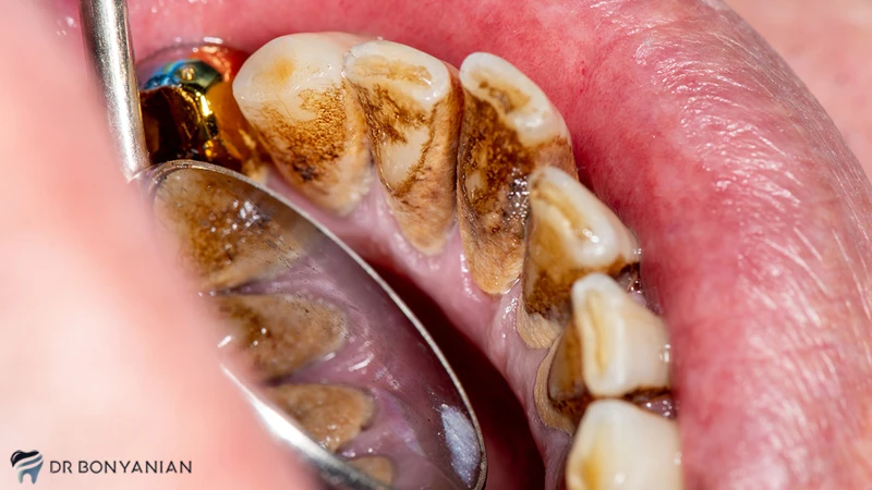 عوارض تشکیل جرم روی دندان