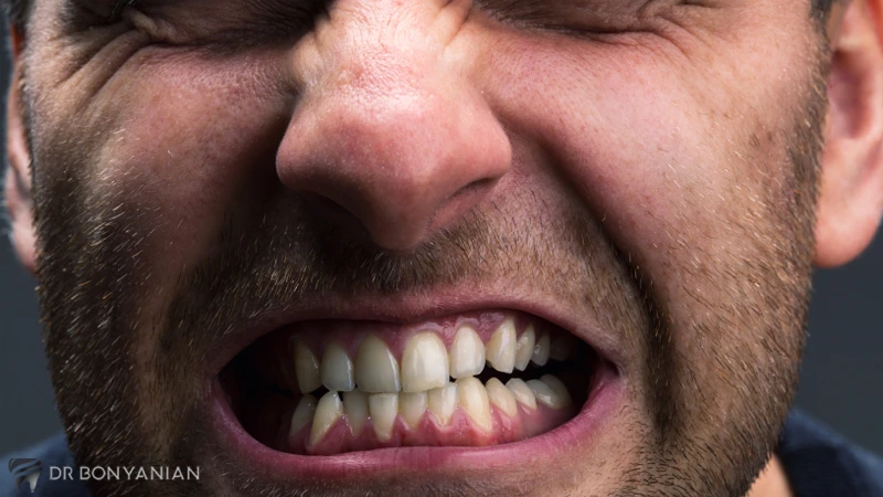علائم شایع دندان قروچه