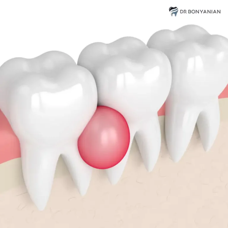 کیست دندان چیست و چه علائمی دارد؟