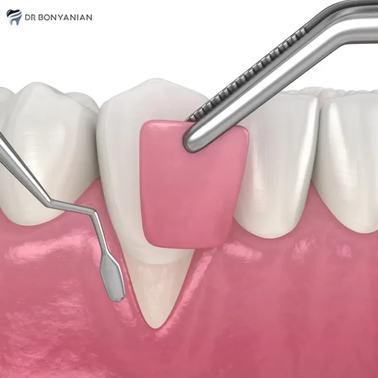پیوند لثه چیست و دوره نقاهت آن چگونه است؟