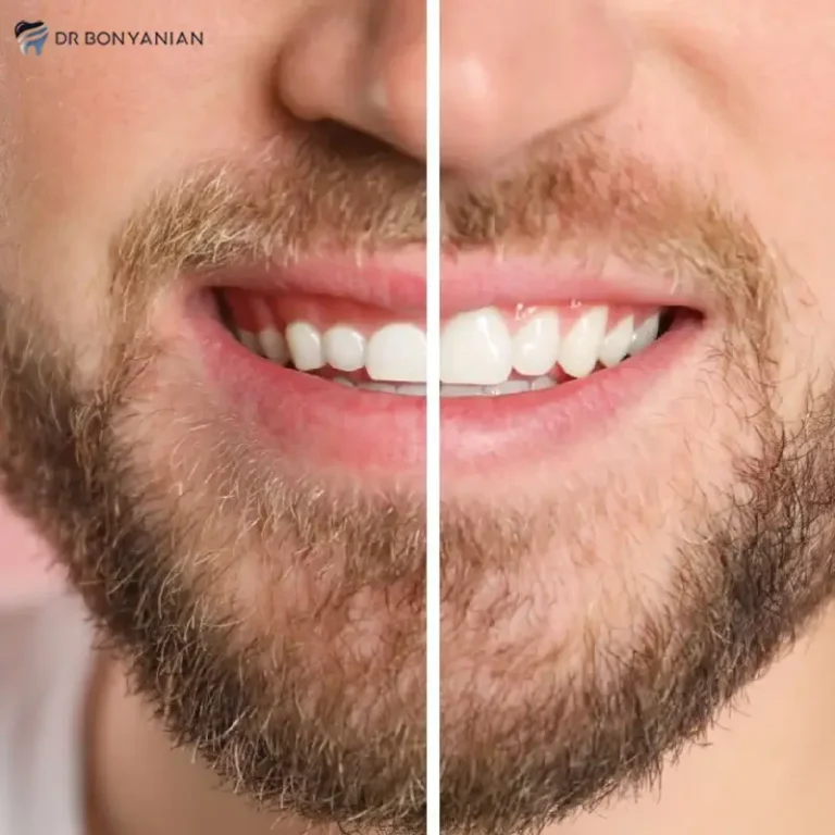 لیفت لثه چیست و برای چه کسانی مناسب است؟
