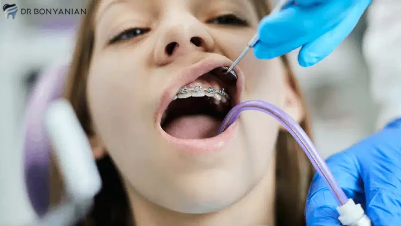بهترین سن برای شروع ارتودنسی دندان کودکان