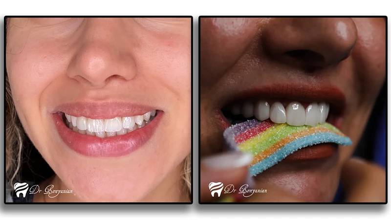 انتخاب رنگ لمینت در کلینیک دندانپزشکی دکتر بنیانیان