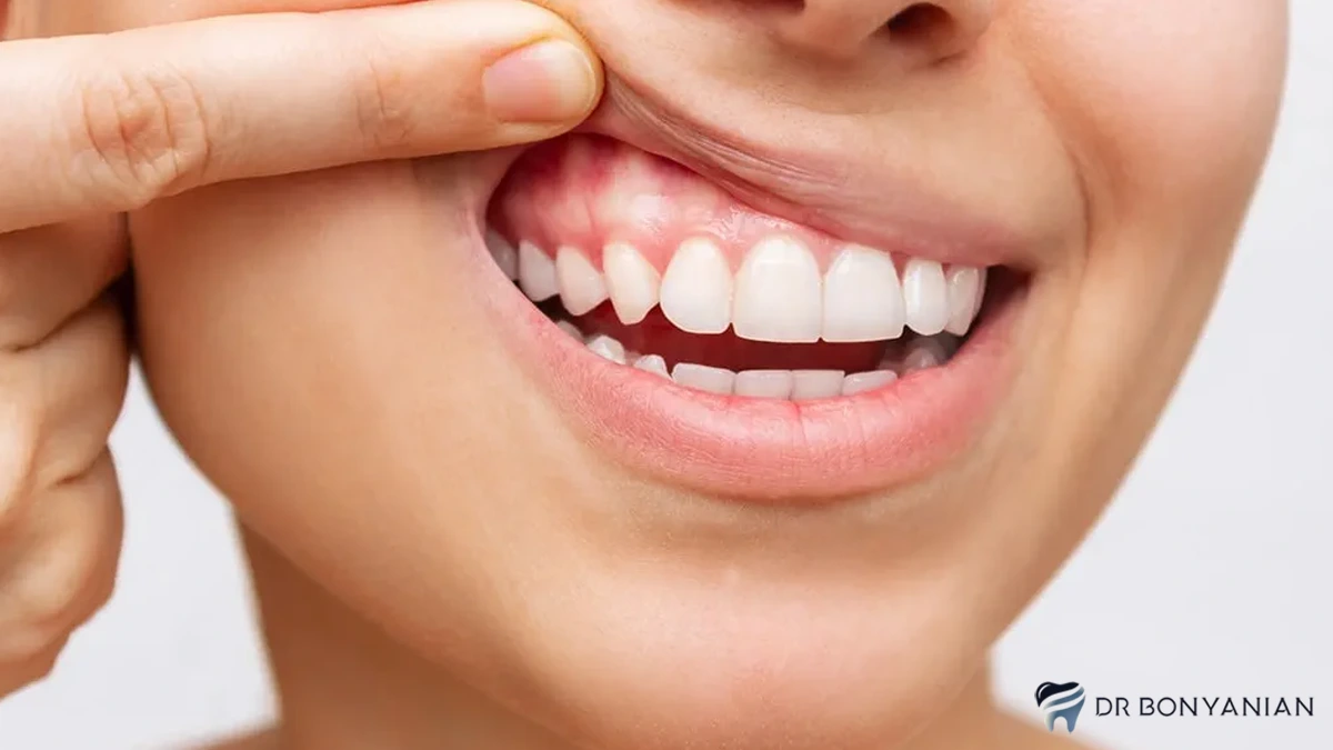 عوارض جراحی لثه