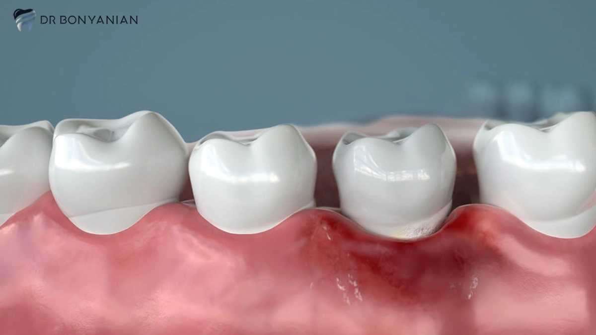 جراحی لثه با لیزر