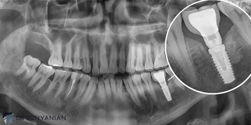 مزایای درمان سریع و به موقع ایمپلنت دندان