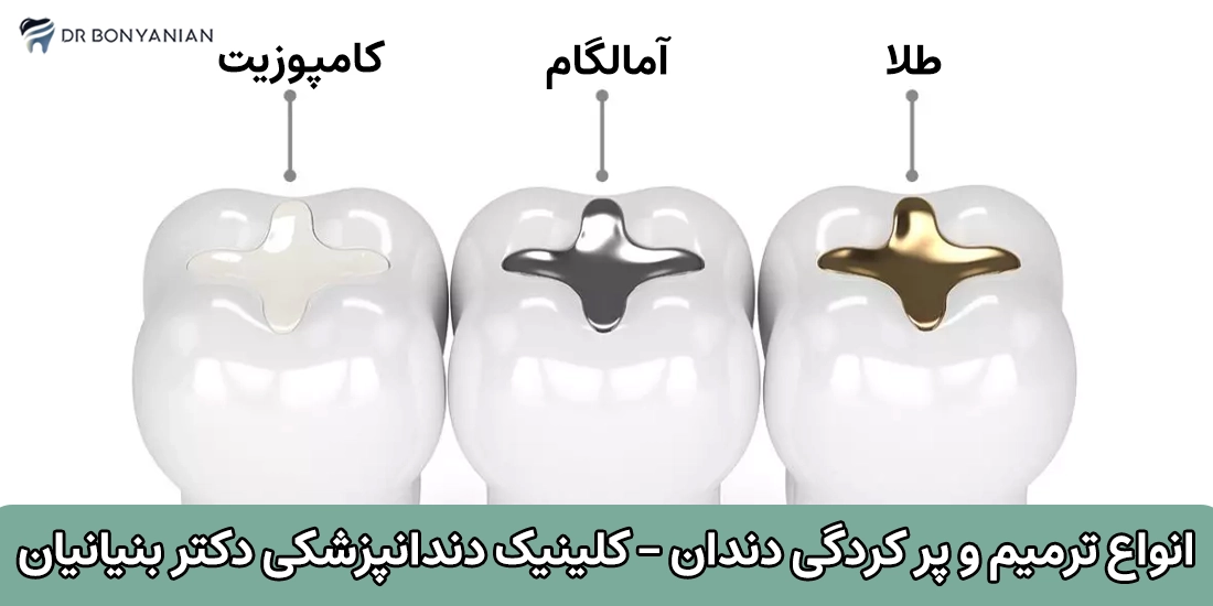 انواع ترمیم دندان
