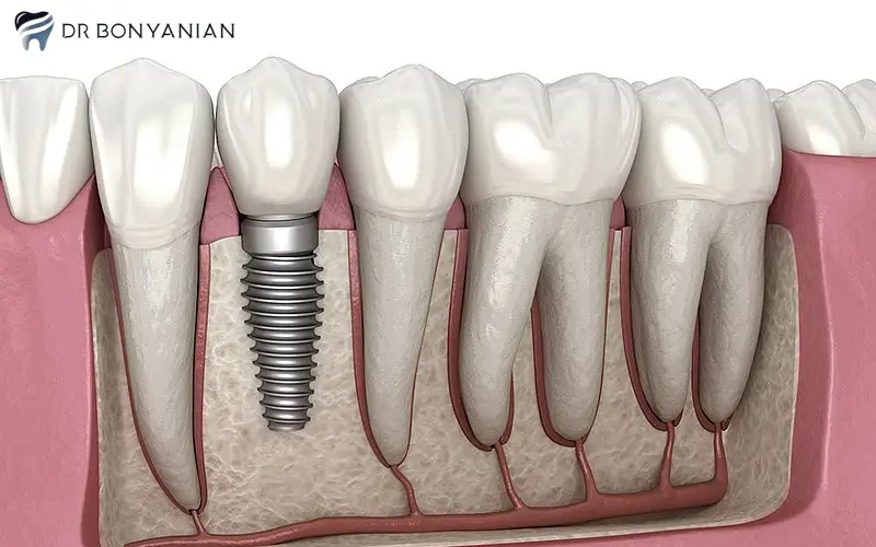 ایمپلنت های دندانی ( Dental Implants )