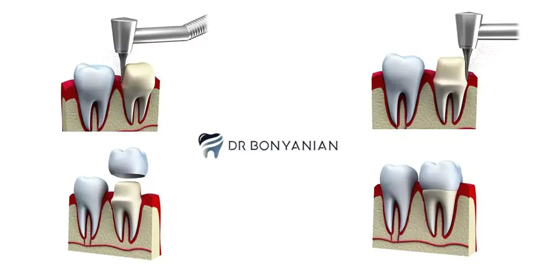 مراحل روکش دندان