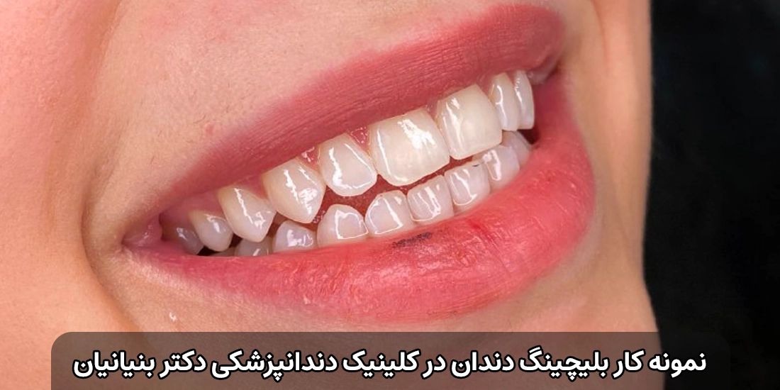 نمونه کار بلیچینگ دندان در کلینیک دندانپزشکی دکتر بنیانیان