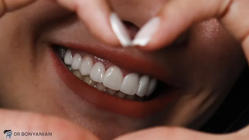 محدودیت سنی لمینت دندان