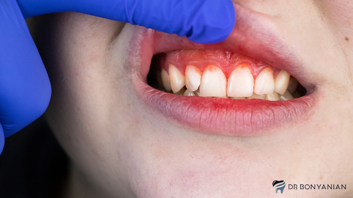 علائم عفونت بعد از استخراج دندان