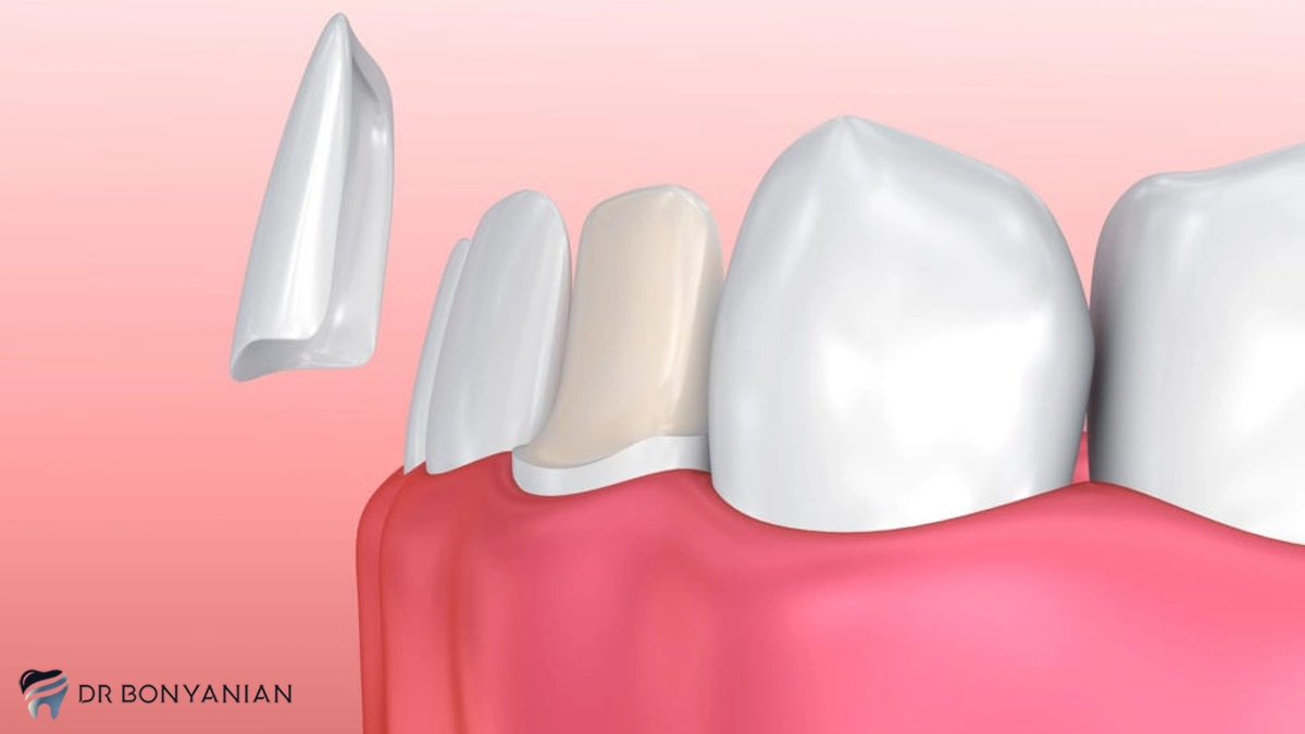 استفاده از لمینت دندان برای اصلاح طرح لبخند