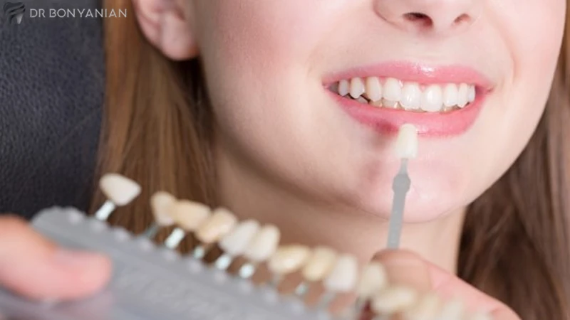 مزایا و معایب لمینت دندان در سنین پایین