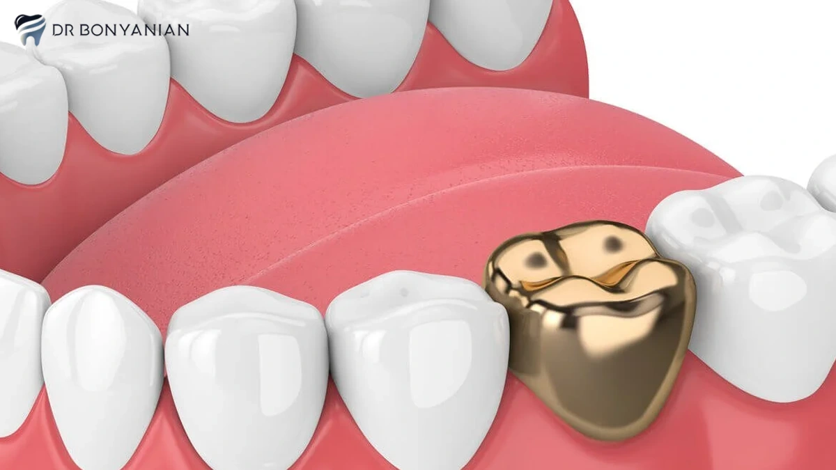 معایب ترمیم دندان با طلا