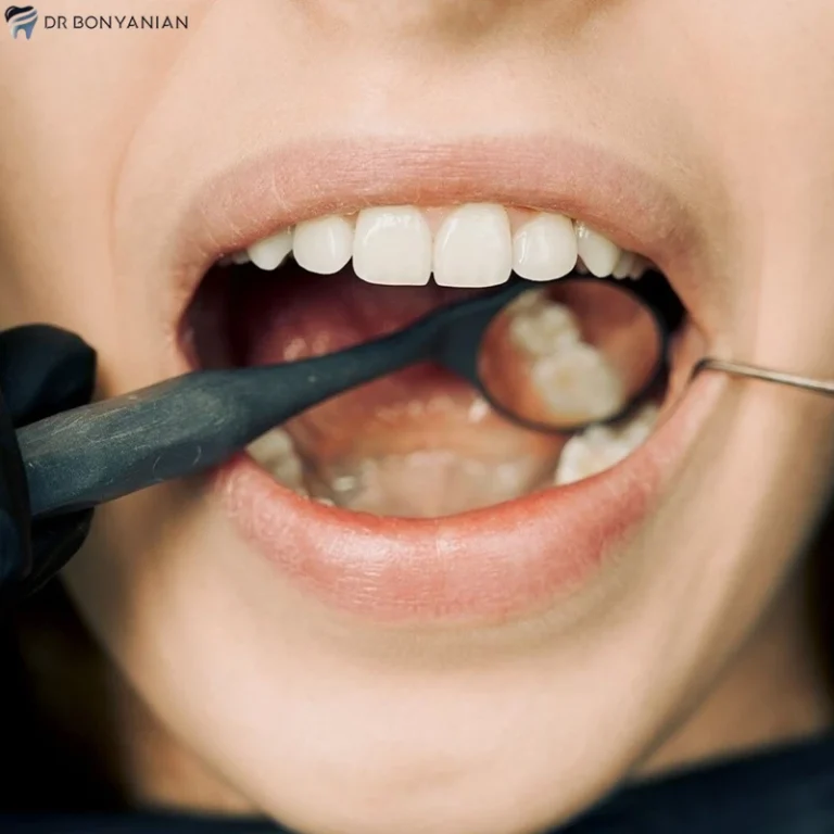همه چیز درباره التهاب لثه بعد از ایمپلنت