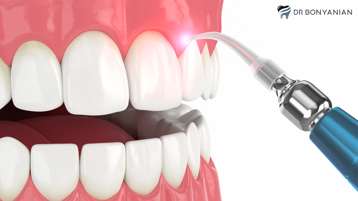 افزایش تاج دندان با لیزر