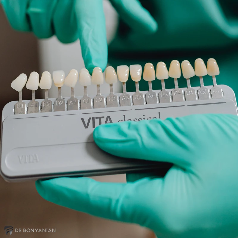 محدودیت سنی لیمنت دندان