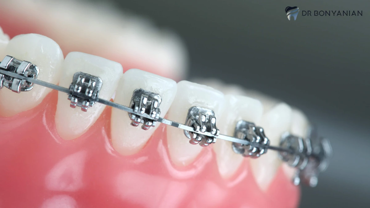 ارتودنسی ثابت دندان با براکت فلزی