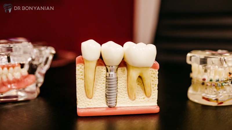 چقدر بعد از کشیدن دندان ایمپلنت کنیم؟