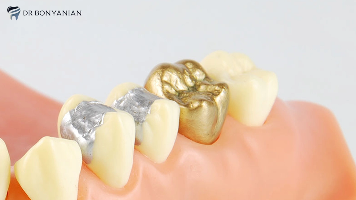 مزایا و معایب ترمیم دندان با کامپوزیت