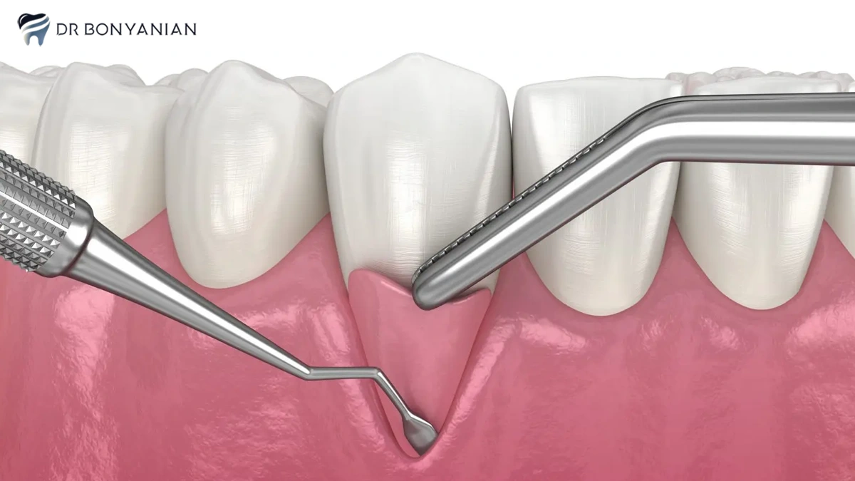 جراحی لثه یا پریو ( periodontics ) چیست؟
