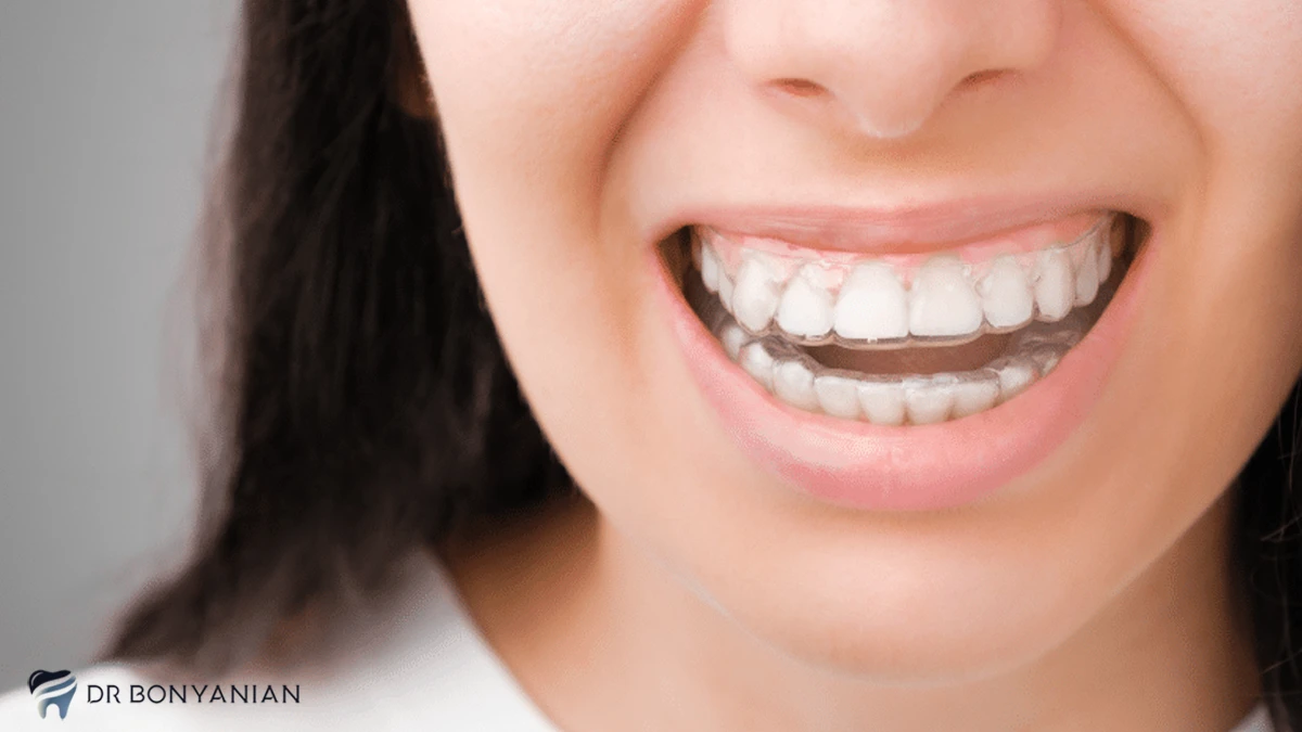ارتودنسی متحرک برای چه دندان‌هایی موثر است؟