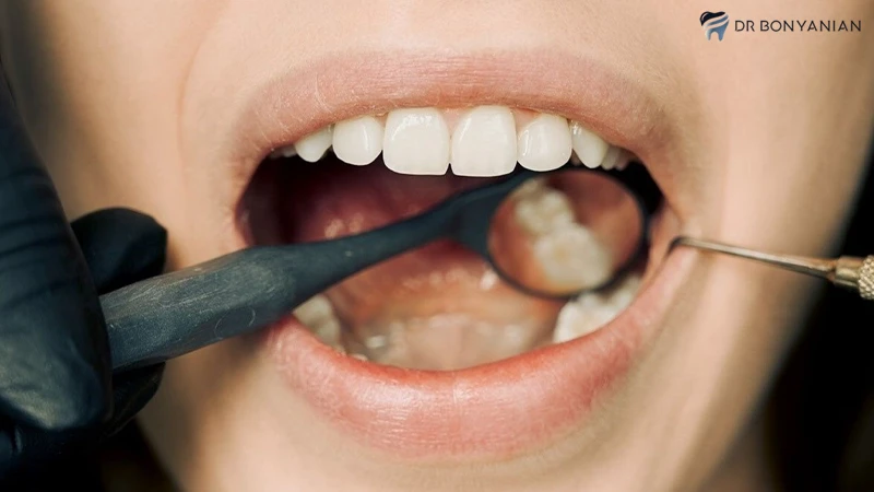  طول عمر ایمپلنت دندان چند سال است ؟