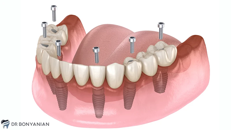 تفاوت ایمپلنتall on 4، با دندان مصنوعی