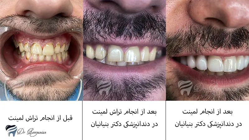 قبل و بعد از تراش دندان برای لمینت