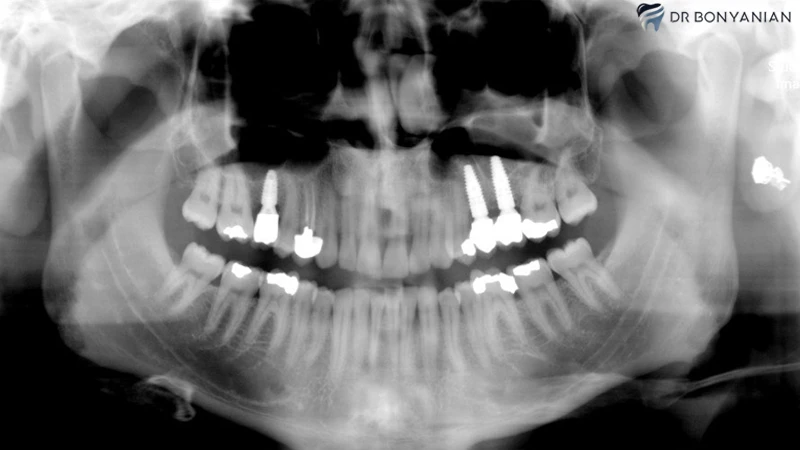 شیمی درمانی پرتو درمانی و ایمپلنت دندان