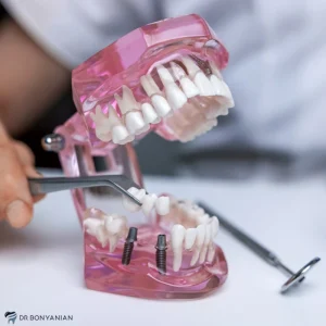 محدودیت های ایمپلنت دندان