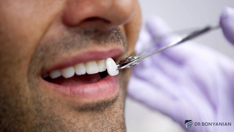 در چه مواردی لمینت دندان توصیه می‌شود؟
