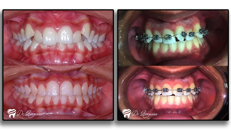 ارتودنسی دندان در کلینیک دندانپزشکی دکتر بنیانیان در تهران